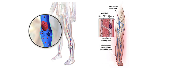 Deep Vein Thrombosis