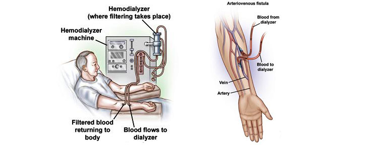 Dialysis Access
