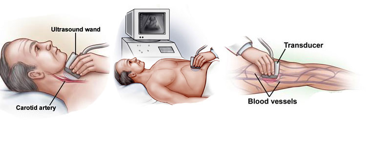 Duplex Ultrasound