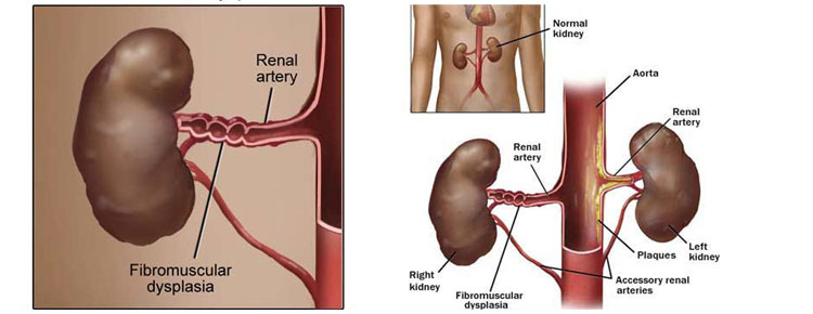 Fibromuscular Disease