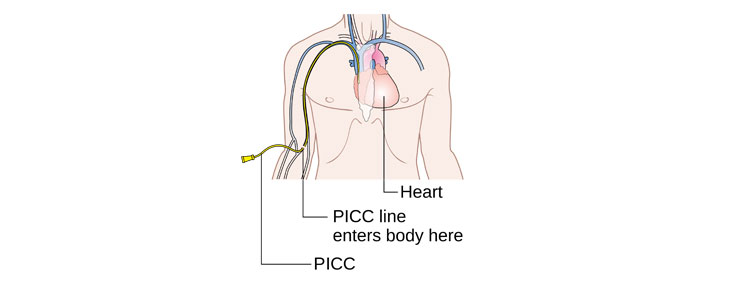 PICC line