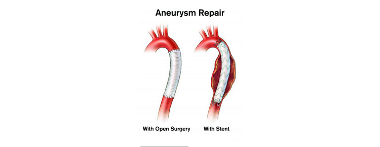 Repair of a Thoracic Aortic Aneurysm