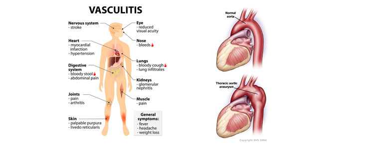Vasculitis